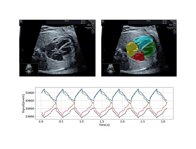 AI-Based Diagnostic Support System for Fetal Arrhythmia Using Ultrasound Videos